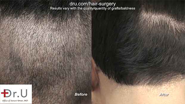 Full Hair Restoration: Results of the Dr.UGraft