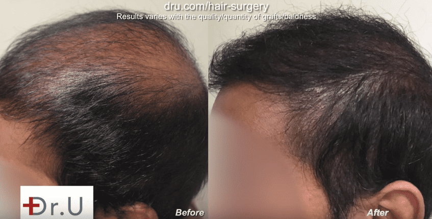 Temple and hairline improved by Dr. U, before and after bad fue hair transplant planning repair