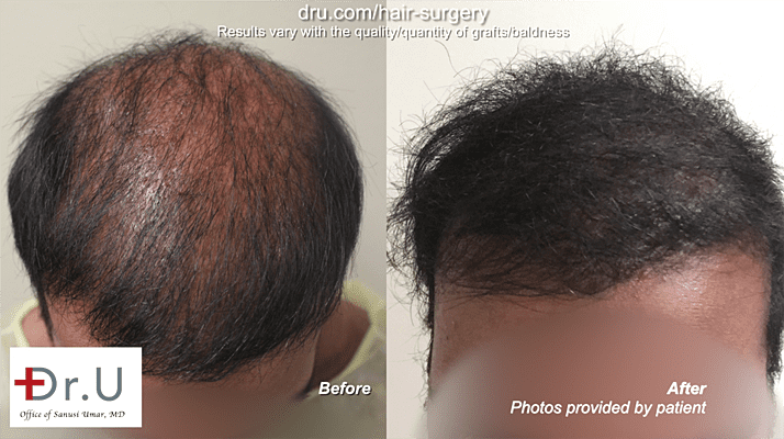 Body Hair Transplant: The DrUGraft method restored this patient's hair to fullness