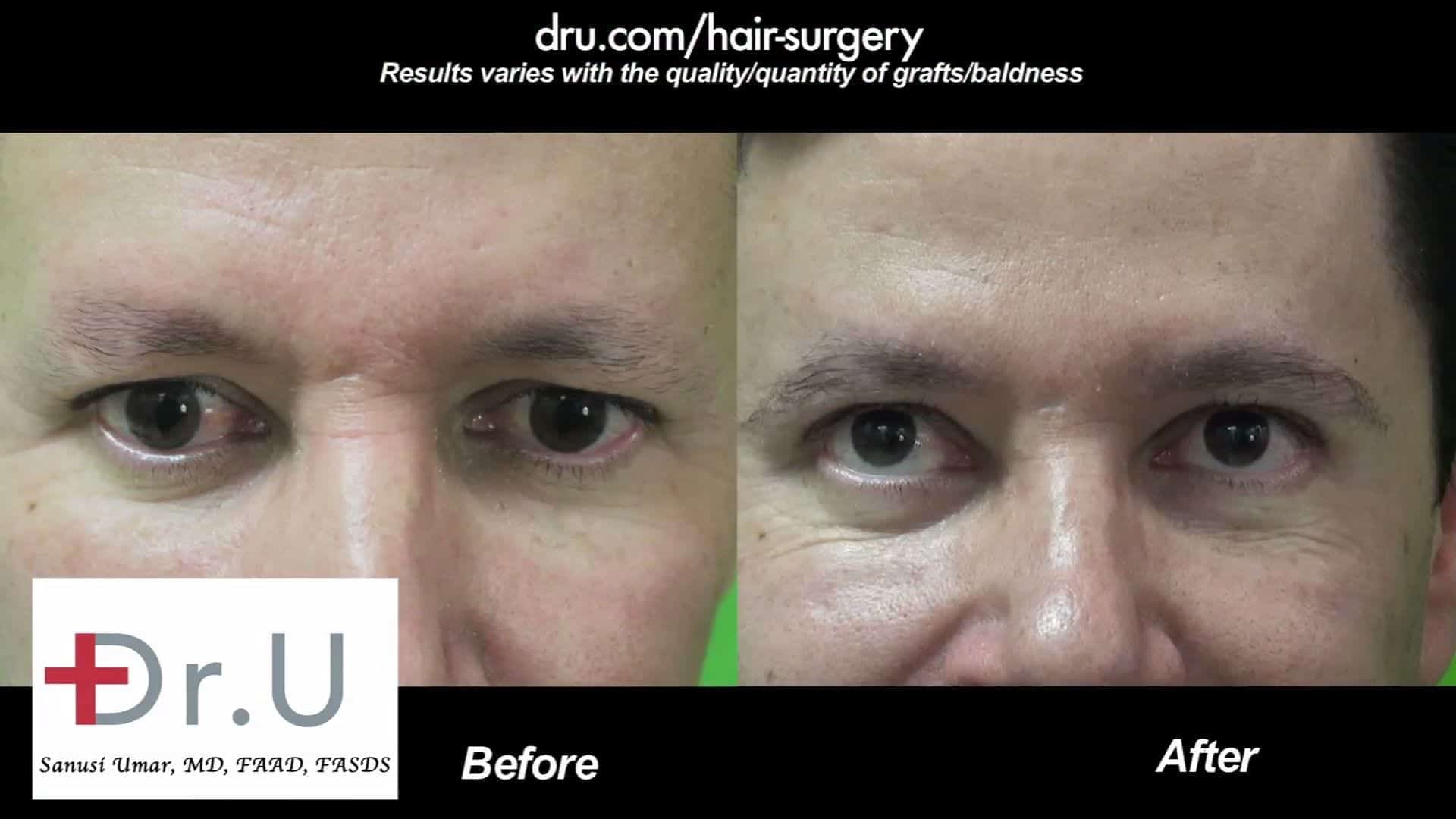 Eyebrow transplantation for men can greatly improve the way the eyes are framed as shown in these before and after photos