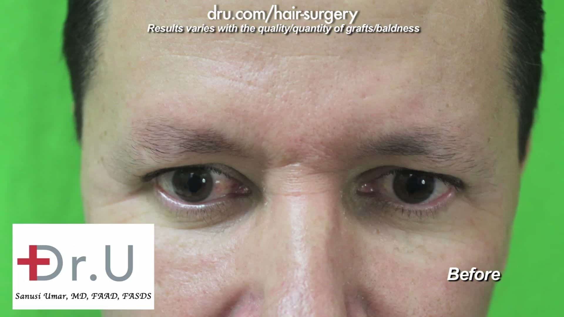 This patient feels his sparse eyebrows are unflattering in appearance and do not frame his face properly. He is, therefore, choosing to undergo an FUE eyebrow transplant for men. 