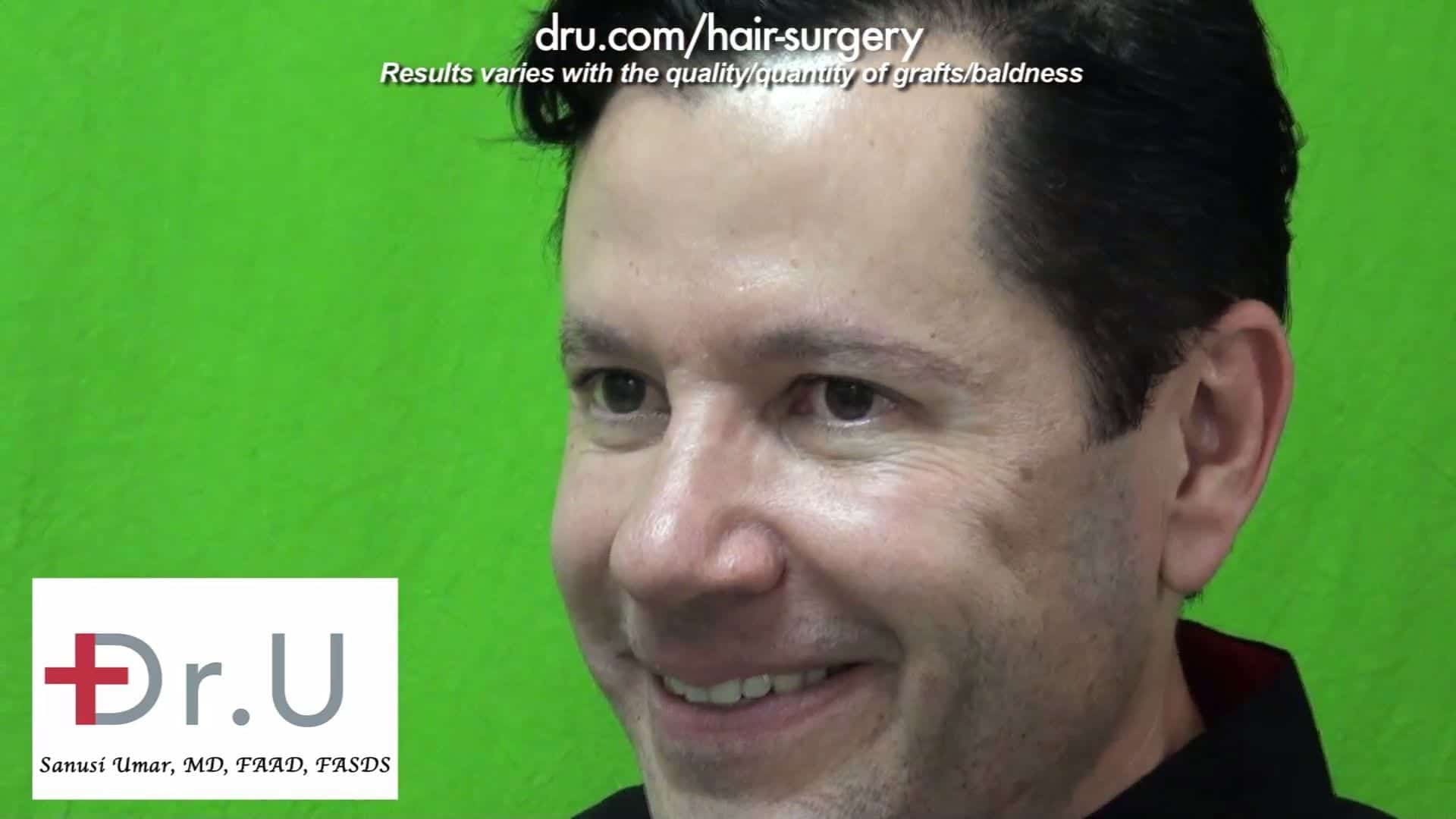 Thicker brows for men can be achieved with an FUE eyebrow transplant. A soft, subtle look is made possible by using thinner hairs from areas like the legs