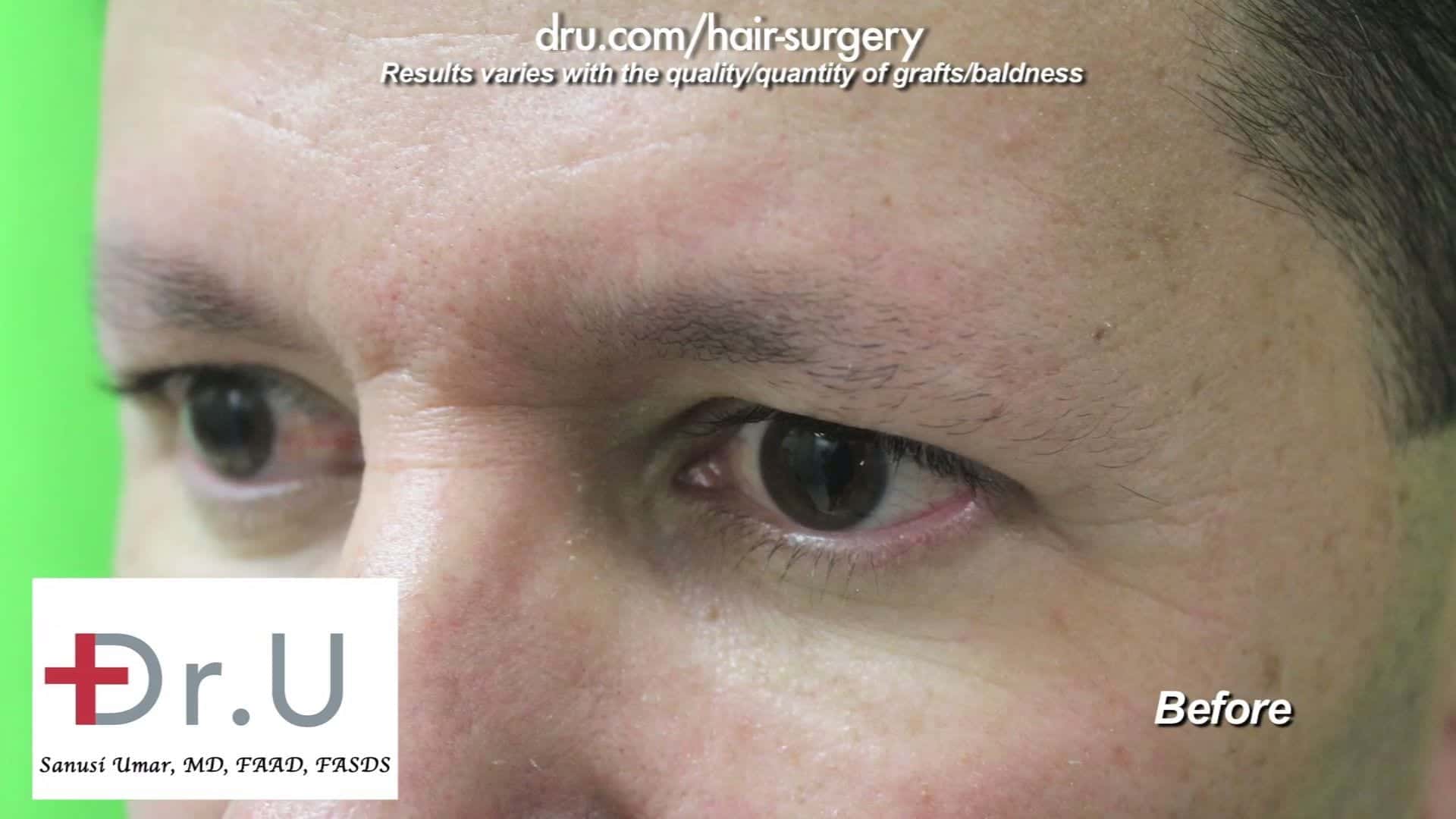 300 leg hair grafts will be transplanted for this male eyebrow restoration surgery to restore a fuller eyebrow look.