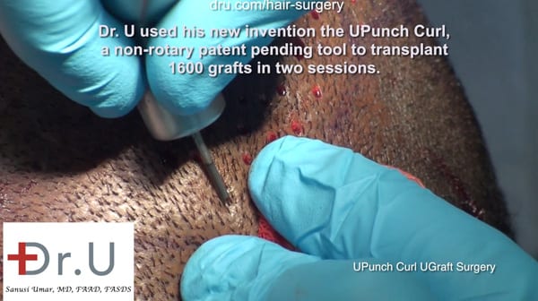Dr. Umar performes FUE hair restoration in black African men with the DrUPunch Curl Dr. Umar performes FUE hair restoration in black African men with the DrUPunch Curl