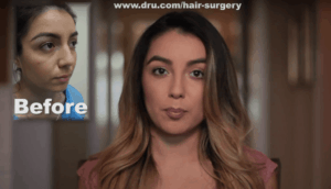 Veelash Eyelash Transplant Results - Dr. U Skin & Hair Clinic V1
