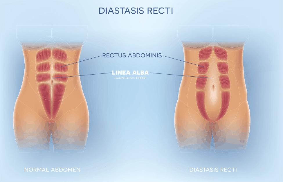 Emsculpt treatment resulted in a non surgical reduction of abdominal separation called diastasis recti