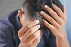 Celebrity Hair Loss