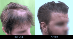 hair transplant before and after