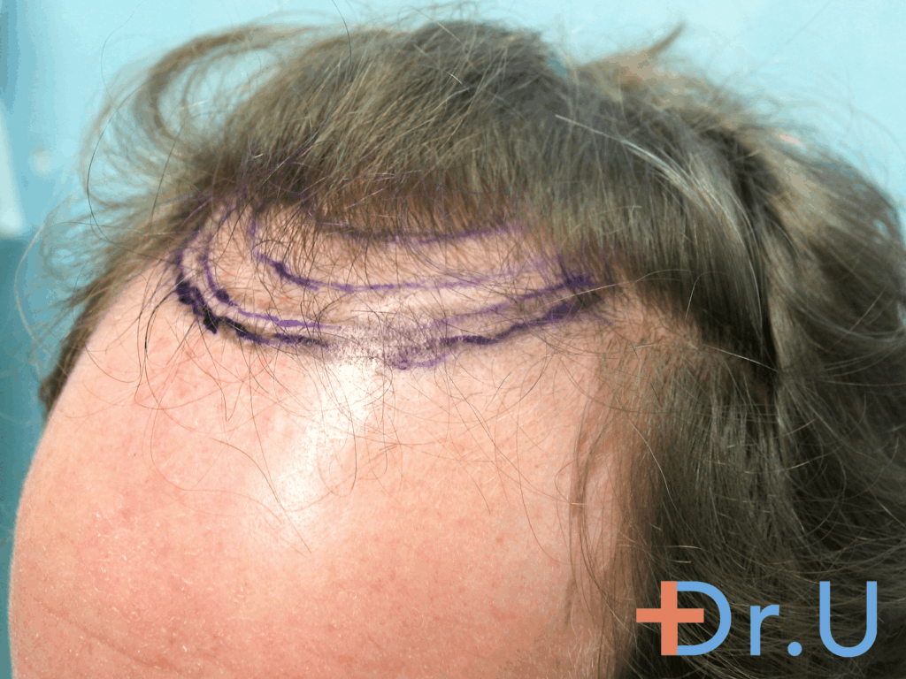 Patient wants to improve his appearance by reducing the margin of hair loss only by a small margin.