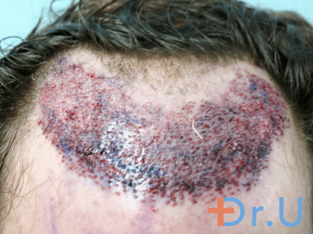 Hair Transplant Recipient Area Following Nape Hair Insertions