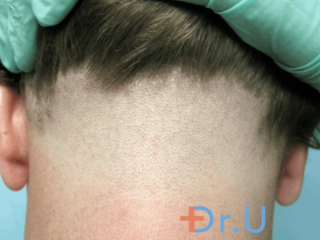 Hair Transplant Nape Donor Area, Following Graft Extraction Phase