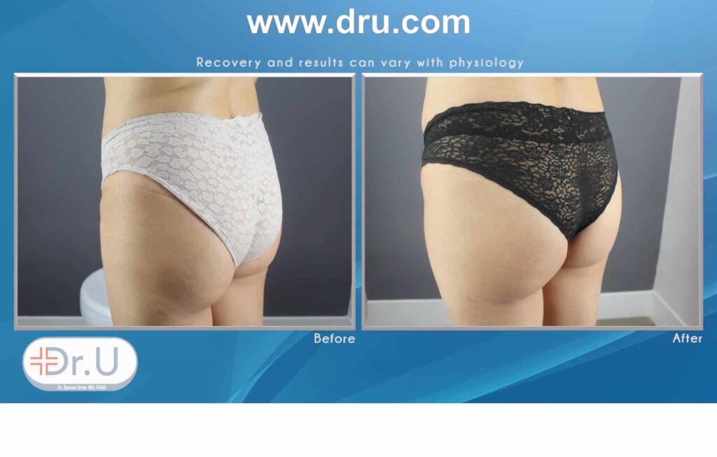 non surgical butt lifting result using HIFEM® (High-Intensity Focused Electromagnetic Energy), Emsculpt