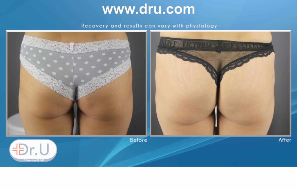 non surgical butt lifting result using HIFEM® (High-Intensity Focused Electromagnetic Energy), Emsculpt