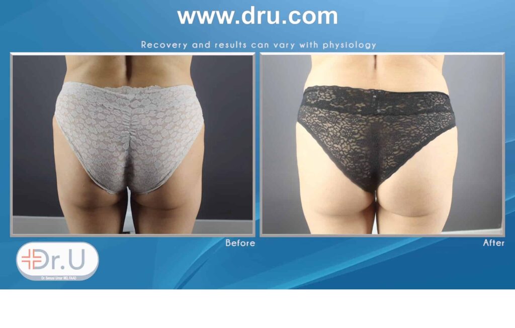 How Does Emsculpt Sculpt Abdomens and Buttocks Without Exercise ?