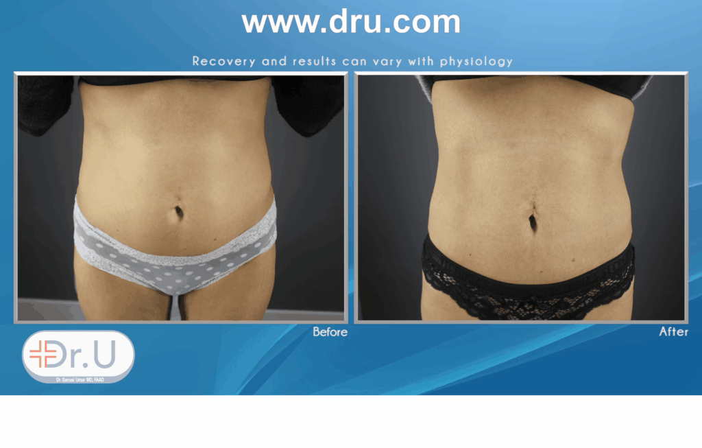 Emsculpt used on the abdomen