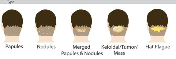 Dr. Bumpinator's Acne Keloidalis Nuchae Type Characterization