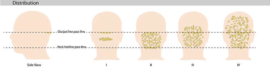 Dr. Bumpinator's Acne Keloidalis Nuchae Distribution Characterization
