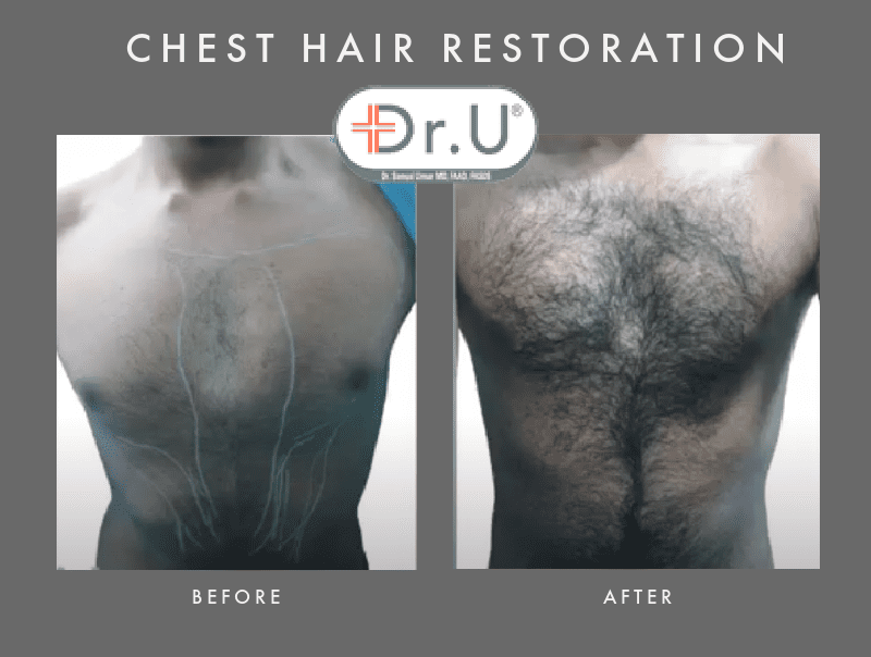 Head to Chest Hair Transplant by Dr.UGraft FUE For Happy Beverley Hills Patient