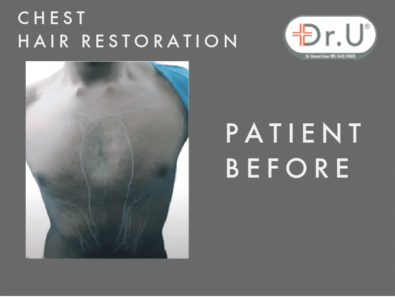 Dr.U's Los Angeles Head to Chest Hair Transplant Patient Before Procedure