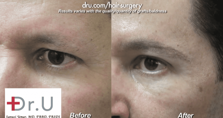 Dr.UGraft ™ technology can be used to transplant nape, leg and other suitable hair types to create thicker eyebrows in men, as well as women. Dr.UGraft ™ technology can be used to transplant nape, leg and other suitable hair types to create thicker eyebrows in men, as well as women.