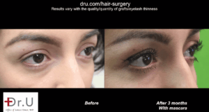 This Dr.UGraft ™ patient represents the world’s first case using leg hair as donor grafts for an eyelash transplant procedure. This Dr.UGraft ™ patient represents the world’s first case using leg hair as donor grafts for an eyelash transplant procedure.
