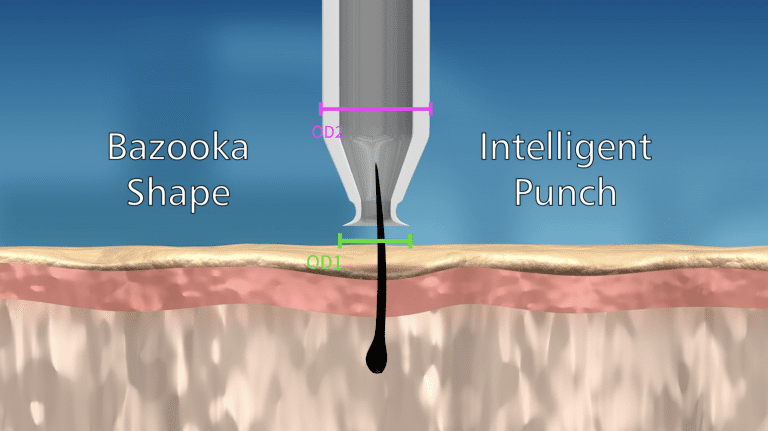 The Dr.UGraft punch system is designed to extract bulkier grafts without having to increase the size of the wound.