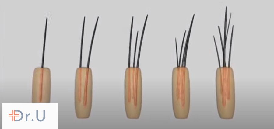 Follicular unit grafts consist of multiple hair follicles wrapped in a bundle. In partial FUE, they are dissected to create two separate hair transplant graft components