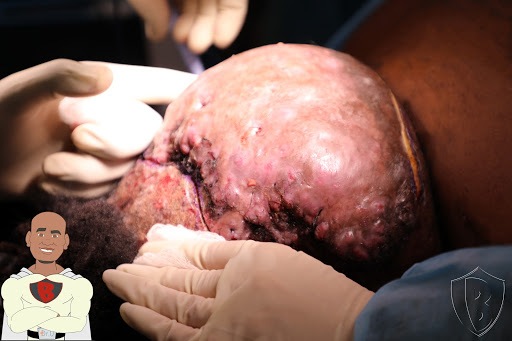 Bumpinator assessing AKN bump during surgery