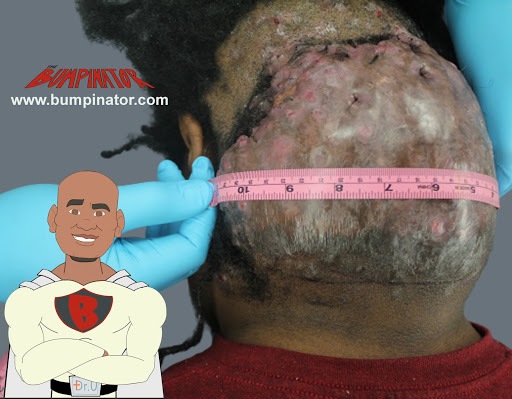 The AKN surgery incision. 