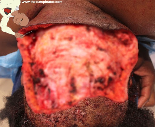 Large sized AKN bump removed right after excision