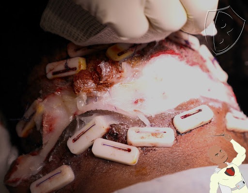 Athena AKN tension sutures closes resulting wound left by the Acne Keloidalis Nuchae bump