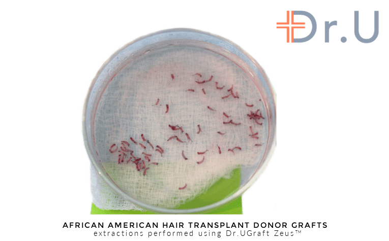 Hair transplant donor grafts harvested using the Intelligent Punch unit of the Dr.UGraft Zeus hair restoration system, invented by Dr.U