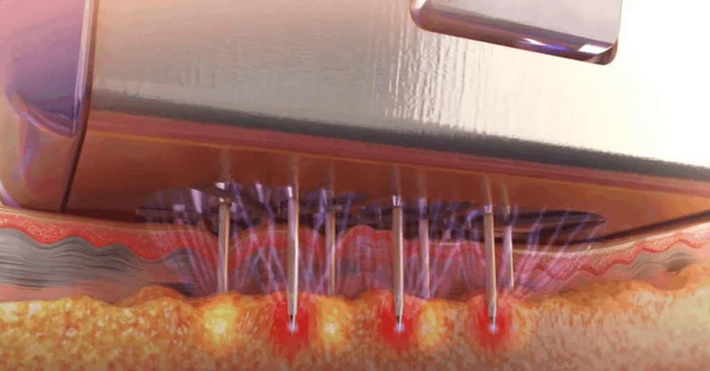 Morpheus8- Fat Remodeling With Radiofrequency