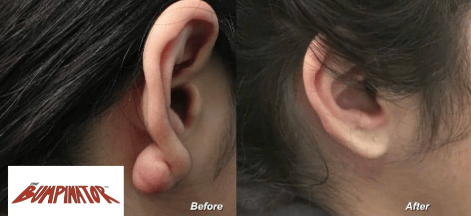 Keloid scar bumps on the earlobe can grow to be quite large. Dr.Bumpinator not only removes them, but also refashions the final earlobe to appear as natural-looking as possible. 