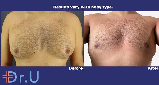 London man had a BodyTite™ procedure to treat his gynecomastia.