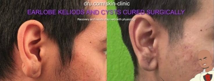 Dr.Bumpinator is on a mission to terminate all unwanted skin bumps, including keloid scars