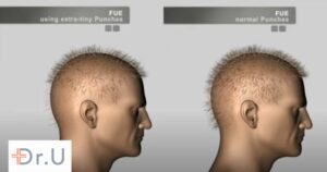 Partial FUE Does Not Multiply Hair