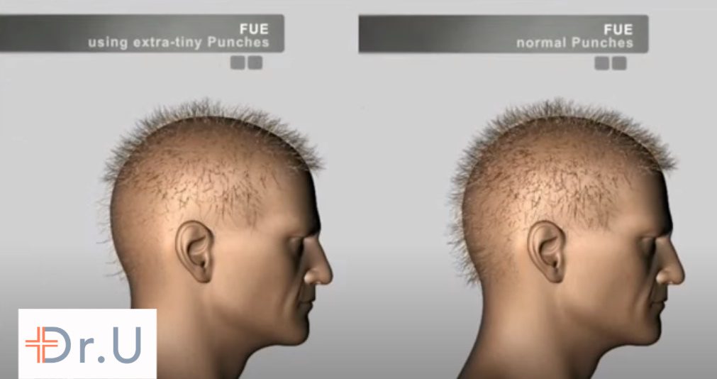 Comparing the results of partial FUE on the left to regular FUE on the right. Partial FUE produces a depleted end appearance. 
