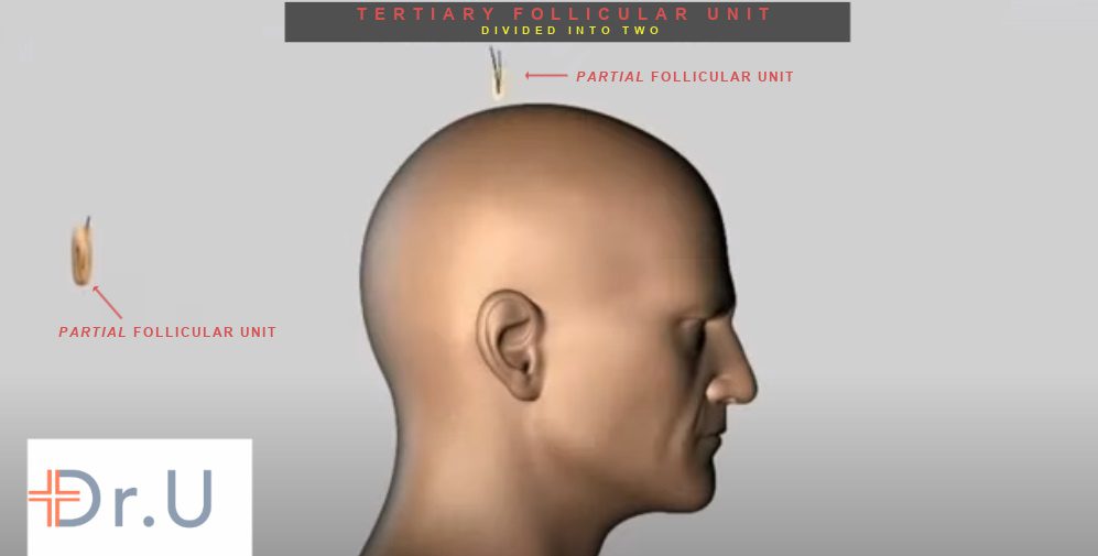 No new hair is created with partial FUE (p-FUE). Dividing a tertiary follicular unit into two components still equates to three hairs. 