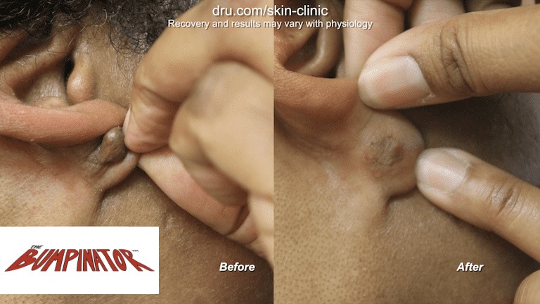 This young lady no longer has an embarrassing bump on the back of her earlobe thanks to her Dr.Bumpinator surgery