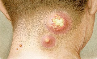 Yellow colored, pus- filled bumps on the back of the neck 