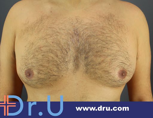 London man struggles with man boobs and requires a gynecomastia surgery by Dr.U*
