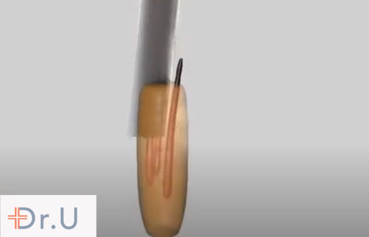 In P-FUE (partial FUE), a tiny hair transplant punch is used to extract a group of hair follicles within a follicular unit grouping. 