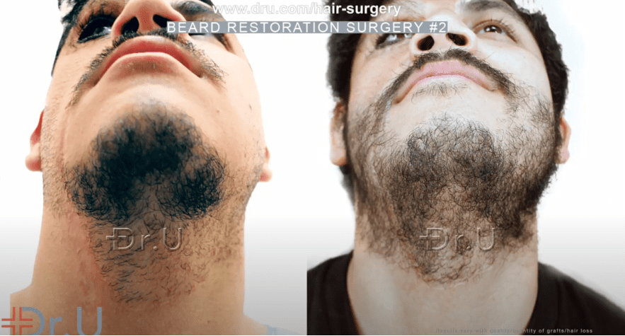 Chin (underside view) of patient's beard restoration results following his second Dr.UGraft Zeus procedure *