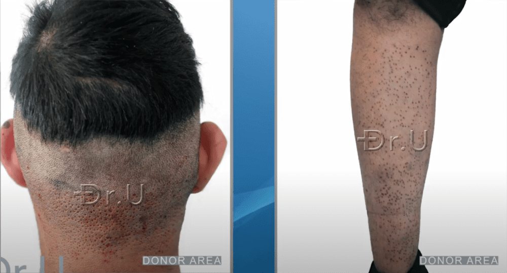 Nape and leg donor regions harvested using Dr.UGraft Zeus supplied the grafts needed to reconstruct the patient's beard