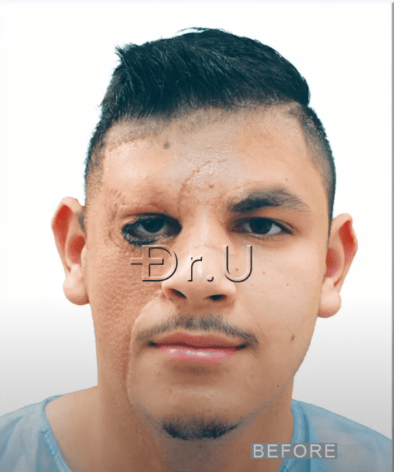 Young Los Angeles patient, featured before his Dr.UGraft Zeus hair transplant procedures, had his congenital nevus replaced by skin grafts taken from his beard and neck area. 