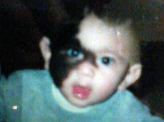 Los Angeles patient as a baby with a large congenital nevus on the right side of his face