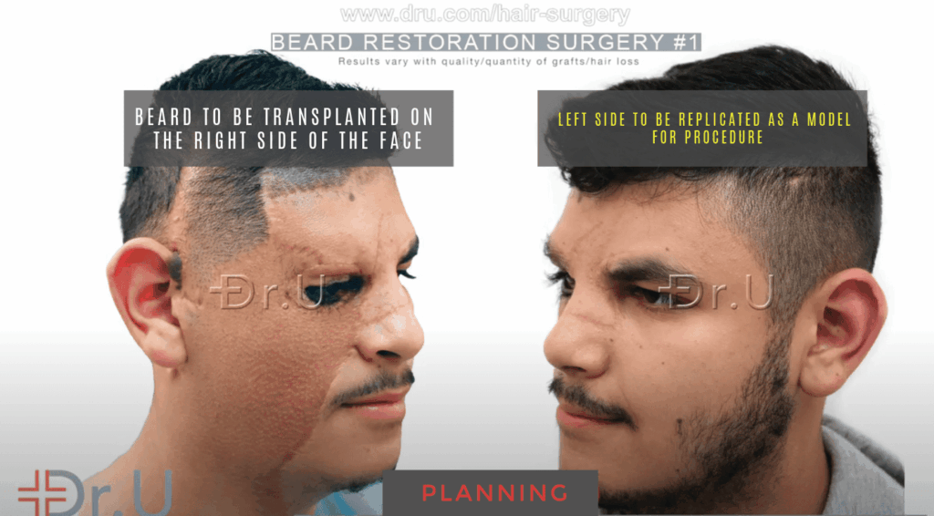 Patient shows normal beard hair growth on the left side of his face. He hopes to achieve the same growth and patterning on the right side with the help of Dr.U