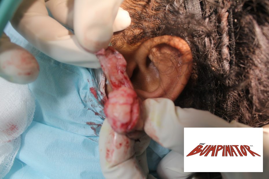 Dr. Bumpinator removes the left earlobe keloid without going outside the keloid lesion and creating a new area of wounding