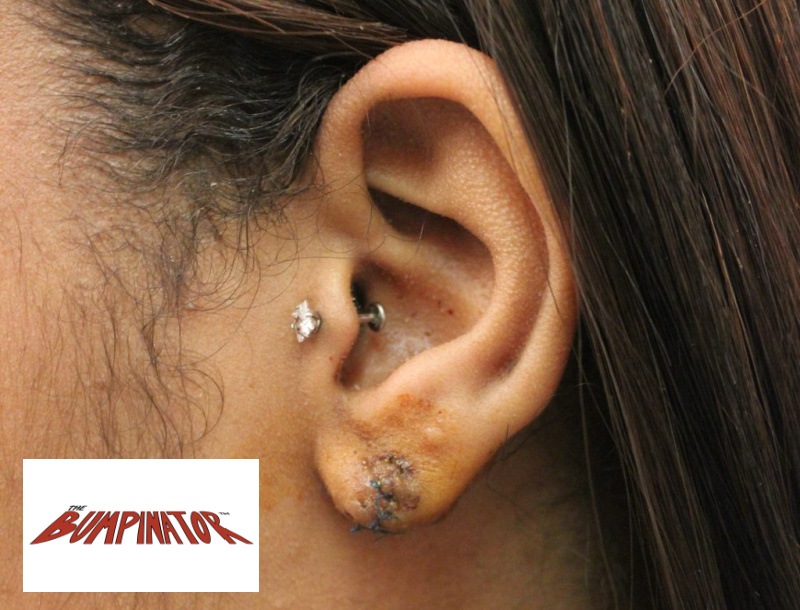 Dr. Bumpinator cut into the keloid to remove it keeping all cuts within the confines of the keloid. He then reconstructed her earlobe using a keloid-harnessed flap.